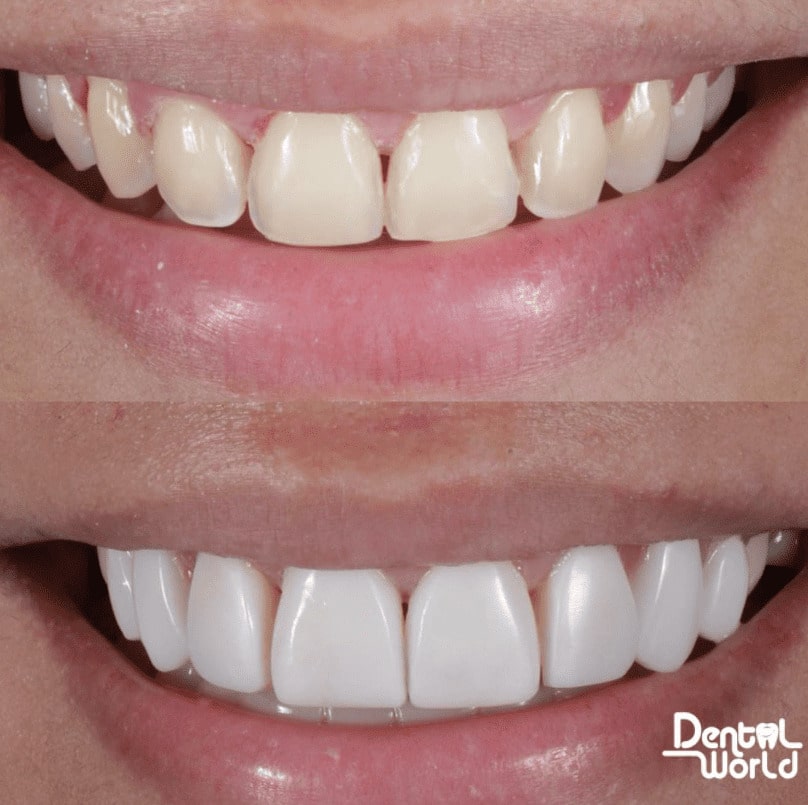 Diseño de sonrisa Dental World