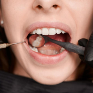 ¿Por qué se desgastan los dientes? Causas comunes y cómo prevenirlo