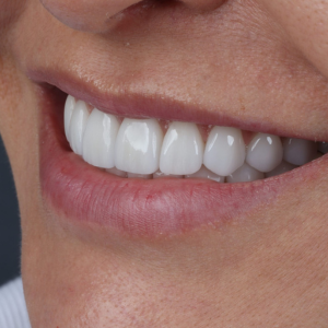 Diseño de Sonrisas: Transforma tu Sonrisa en Cartagena con Resultados Naturales