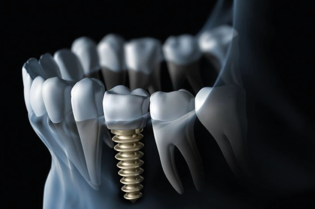 Implantes Dentales en Cartagena para Pacientes en EE.UU.: Calidad, Ahorro y Confianza
