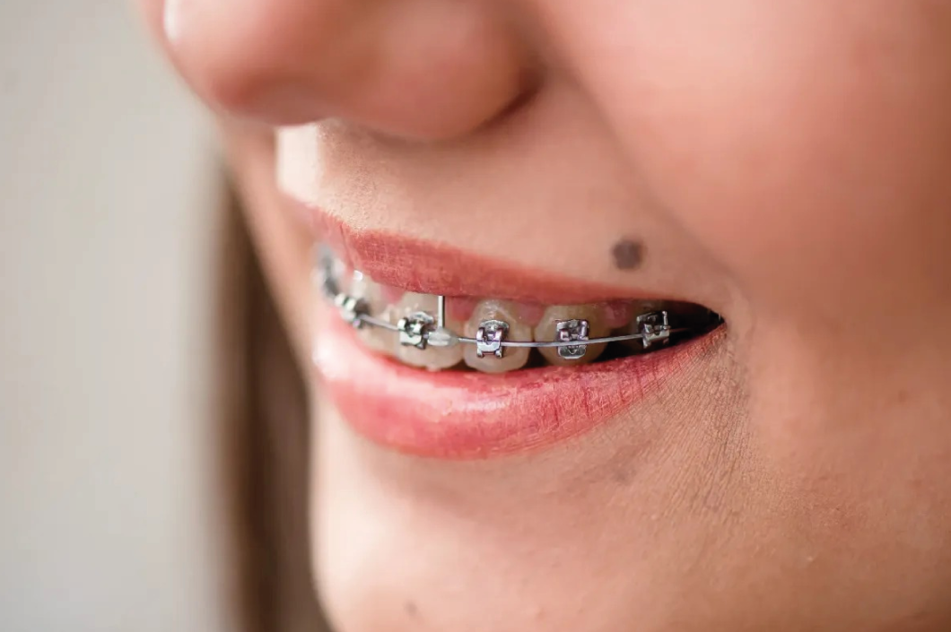 Brackets de autoligado: la revolución en ortodoncia moderna