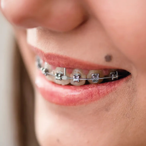 Brackets de autoligado: la revolución en ortodoncia moderna