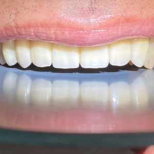 Coronas libres de metal: estética y resistencia en tu sonrisa