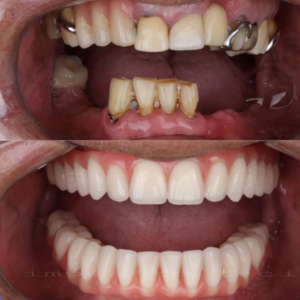 Rehabilitación de implantes dentales en Cartagena: la solución definitiva para recuperar tu sonrisa