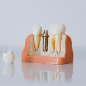 Rehabilitación de implantes dentales en Cartagena: la solución definitiva para recuperar tu sonrisa