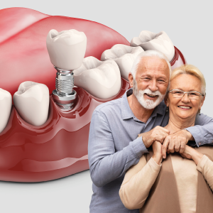 Rehabilitación de implantes dentales en Cartagena: la solución definitiva para recuperar tu sonrisa