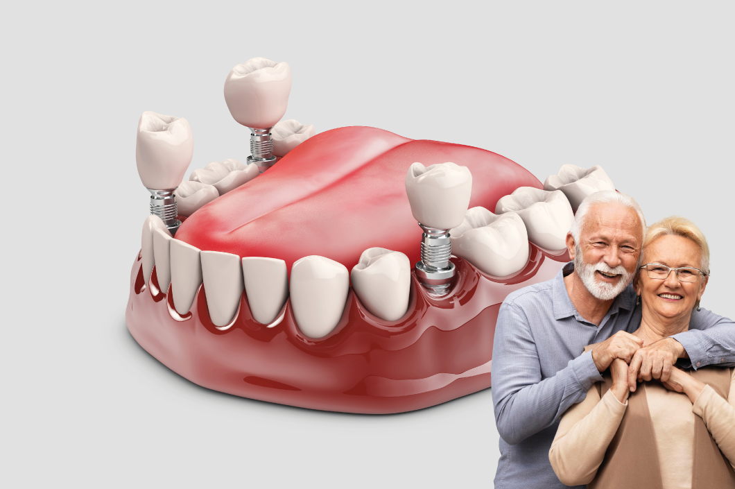 Rehabilitación de implantes dentales en Cartagena: la solución definitiva para recuperar tu sonrisa