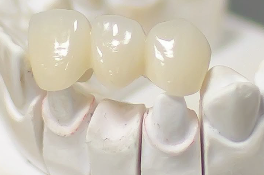 Coronas libres de metal: estética y resistencia en tu sonrisa