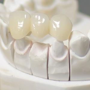 Coronas libres de metal: estética y resistencia en tu sonrisa
