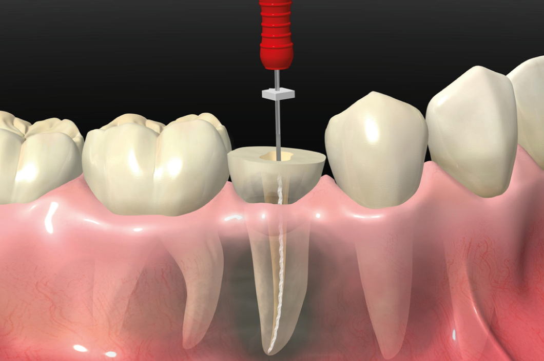 ¿Una endodoncia puede fallar? Causas y soluciones
