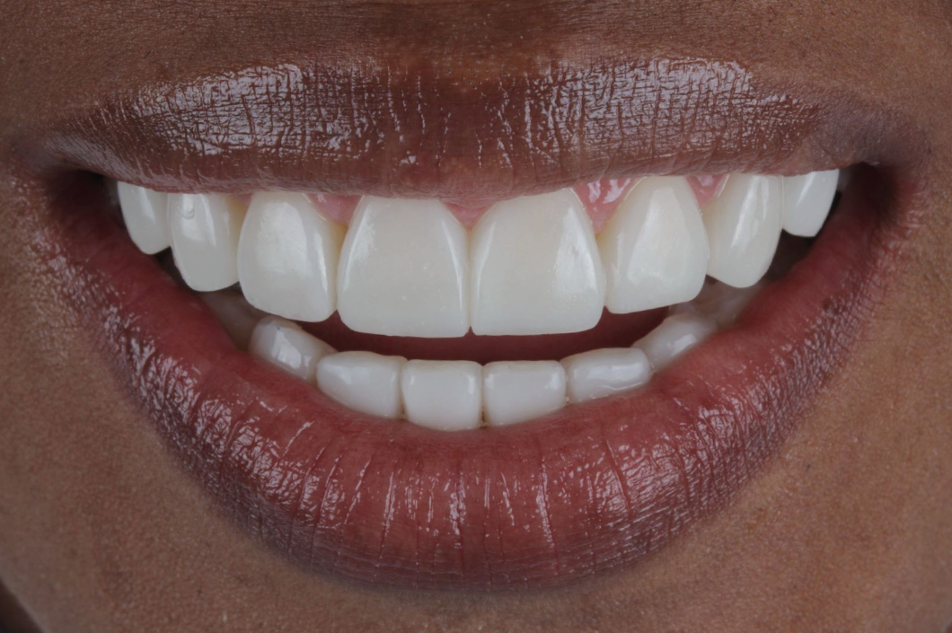 Resinas de Alta Estética y Resistencia: La Solución Moderna para Restaurar tu Sonrisa