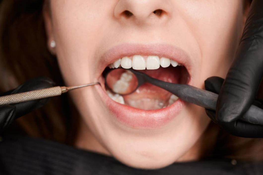 ¿Por qué se desgastan los dientes? Causas comunes y cómo prevenirlo