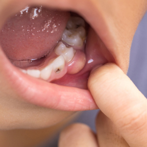 Todo acerca de la pulpectomía: tratamiento para salvar los dientes de leche