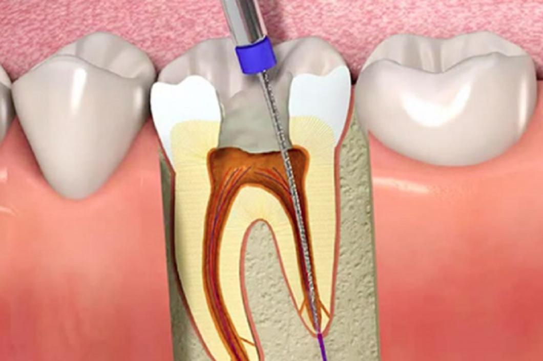 Tratamiento de conducto: los errores más comunes y cómo prevenirlos
