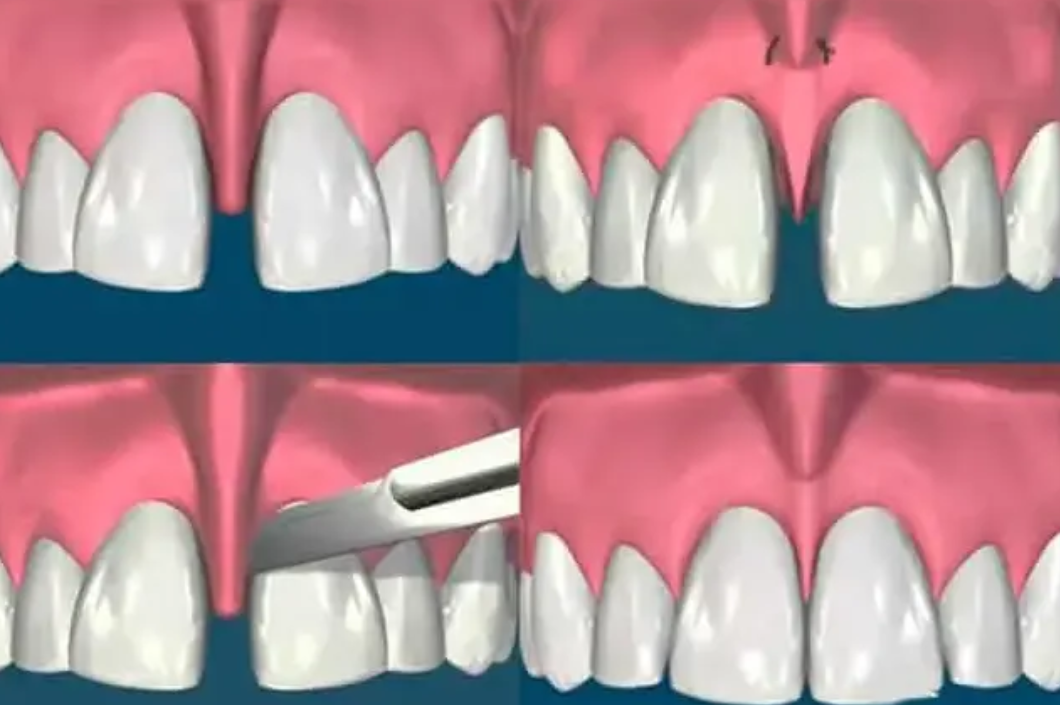 Frenectomía: mejora tu pronunciación y estética con una cirugía sencilla