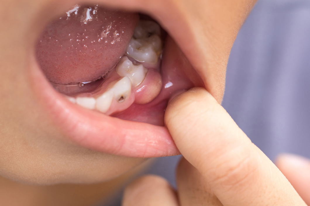 Todo acerca de la pulpectomía: tratamiento para salvar los dientes de leche