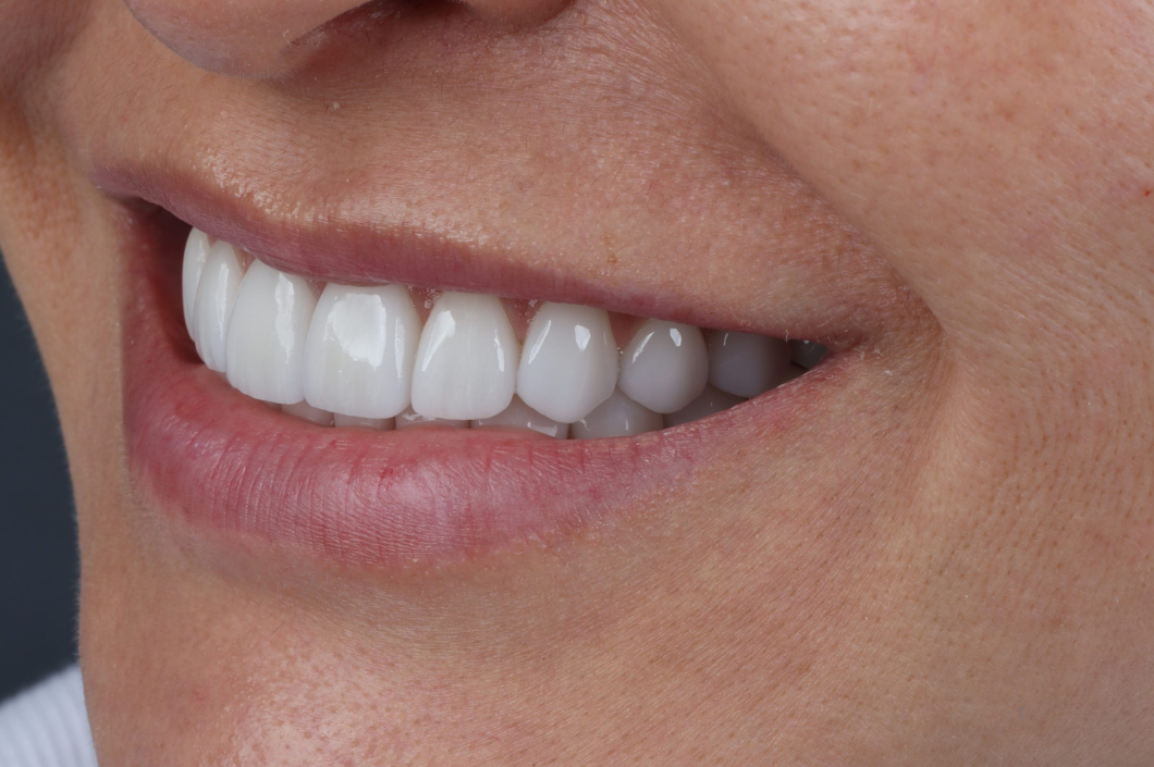 Diseño de Sonrisas: Transforma tu Sonrisa en Cartagena con Resultados Naturales