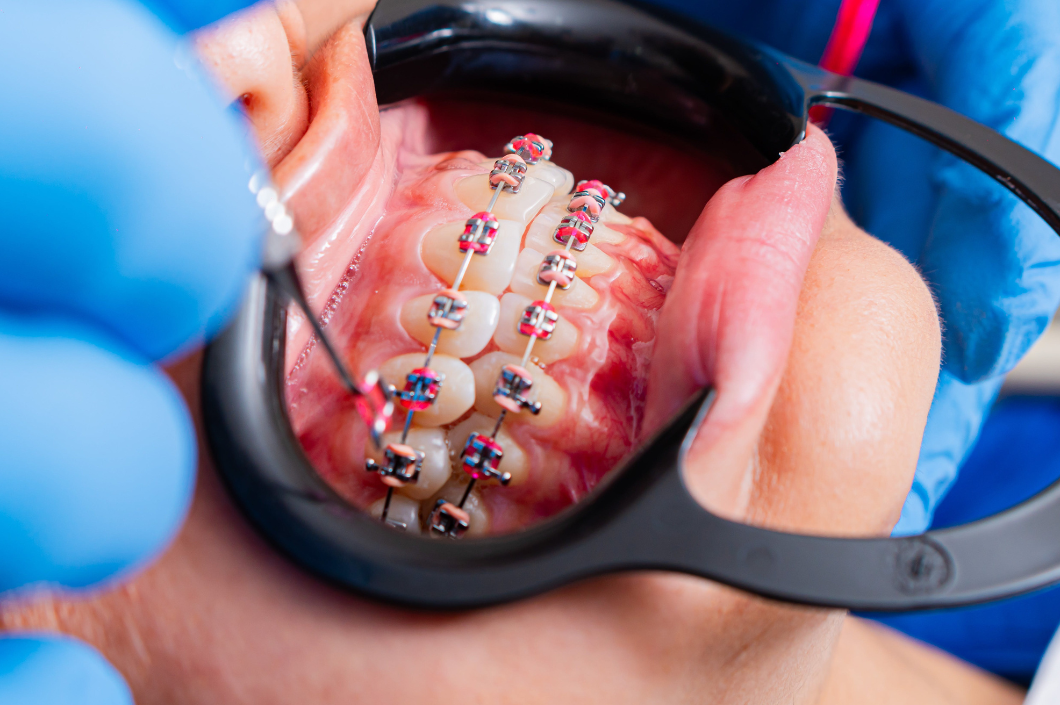 Ortodoncia invisible: ¿vale la pena? Beneficios frente a los brackets tradicionales